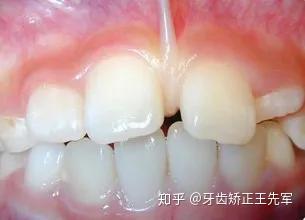 另外,多生牙或者乳牙阻生,也会造成牙齿间隙大,并影响牙齿排列.