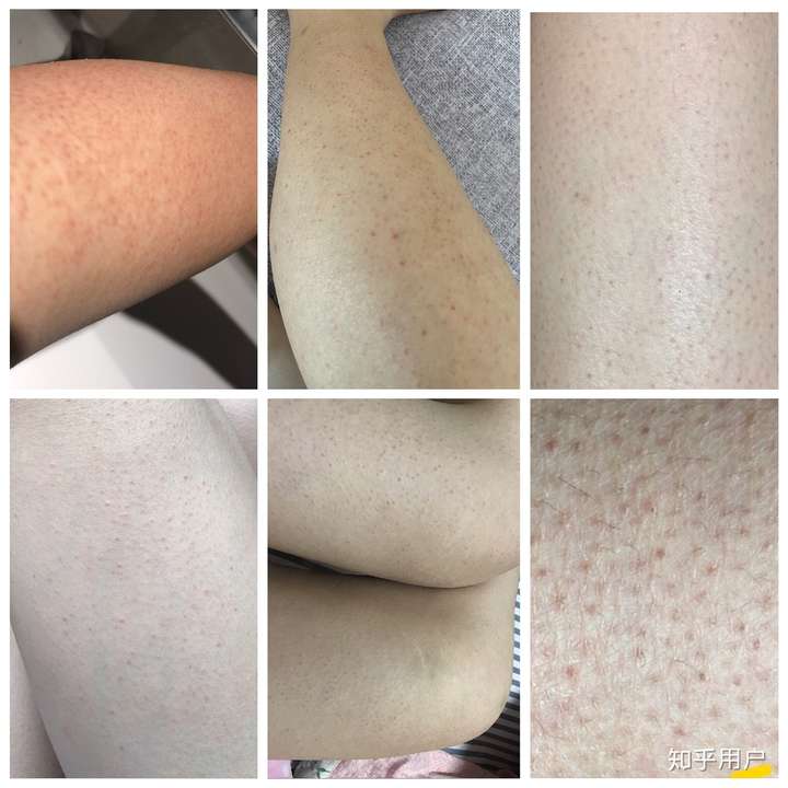 皮肤表面有凸起的小疙瘩,仔细观察里面有未冒头的汗毛,抓挠抠破就