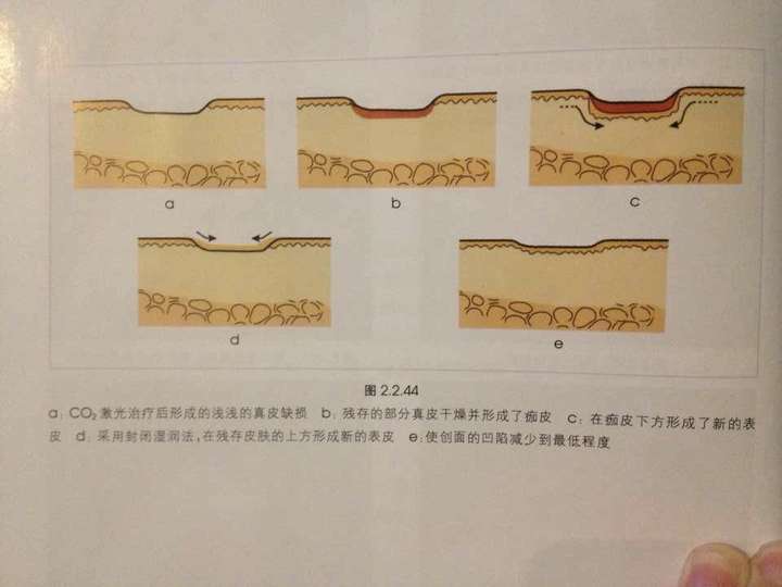 要让伤口愈合得快,防止伤口感染,就要保持伤口部位透气性,包扎的纱布