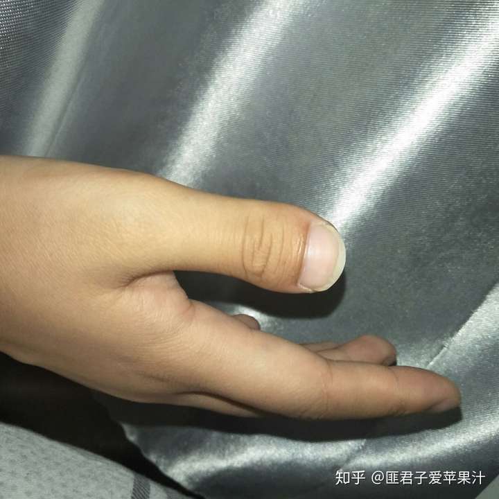 为什么我的大拇指又宽又短?