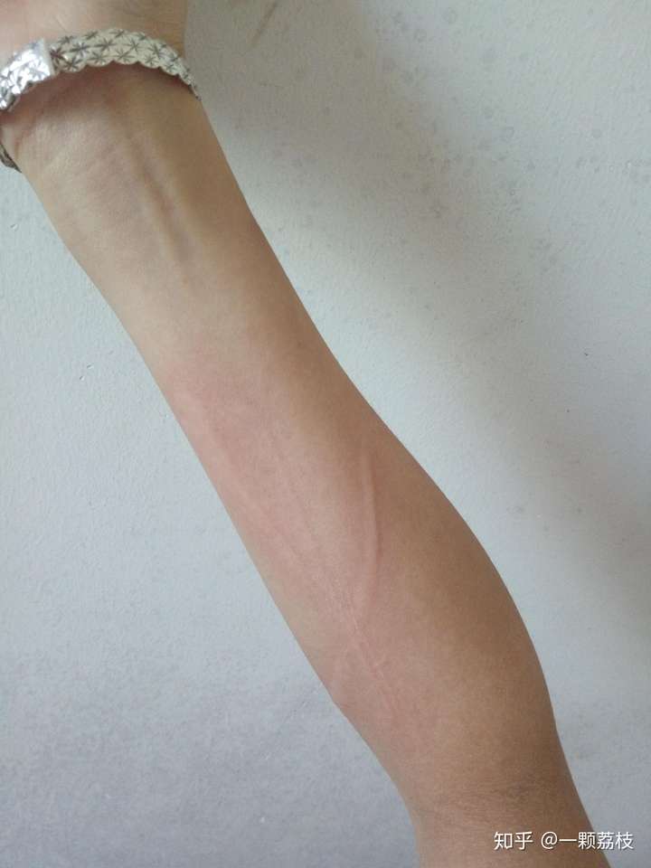 用指甲刮一下就会突起一道疤来 有时候无聊还会很非主流的在上面刻字