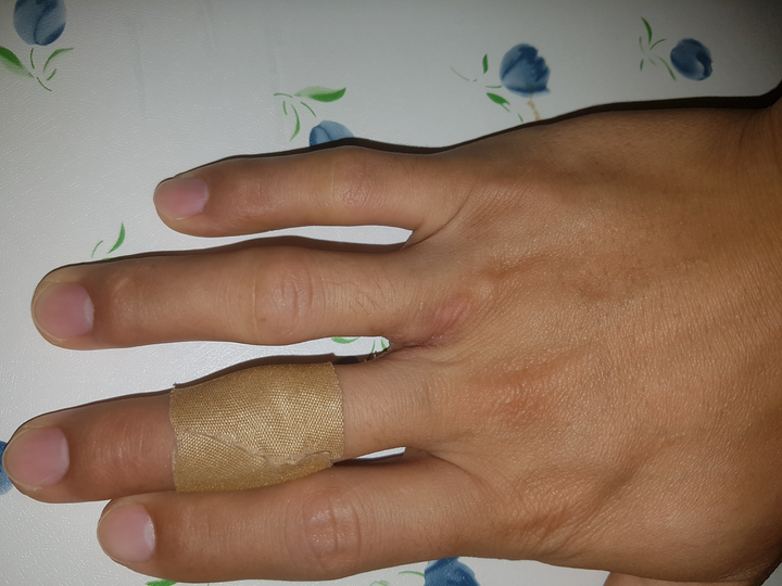 关节肿的这么大  现在中指贴了个狗皮膏药试下  哎 手指都变形了