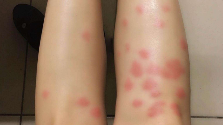 以吸血为生,被跳蚤叮咬后,每个人表现出来的症状不一样,正常的是鼓包