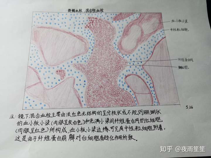 肉芽组织和血栓的红蓝铅笔手绘图怎么画救救孩子吧