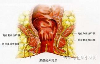 肛瘘对生活有哪些影响