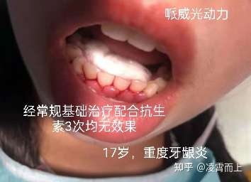 口腔科普#发生在身边的牙龈炎