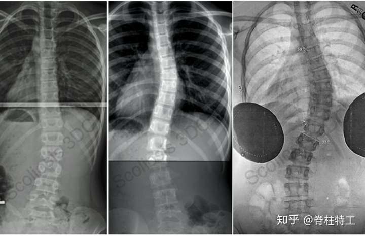 脊柱侧弯矫正关于矫形器支具的几个问题