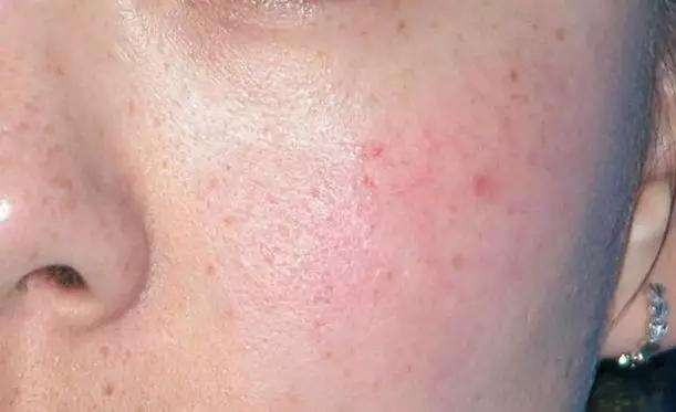 如何改善脸色暗沉的状态?