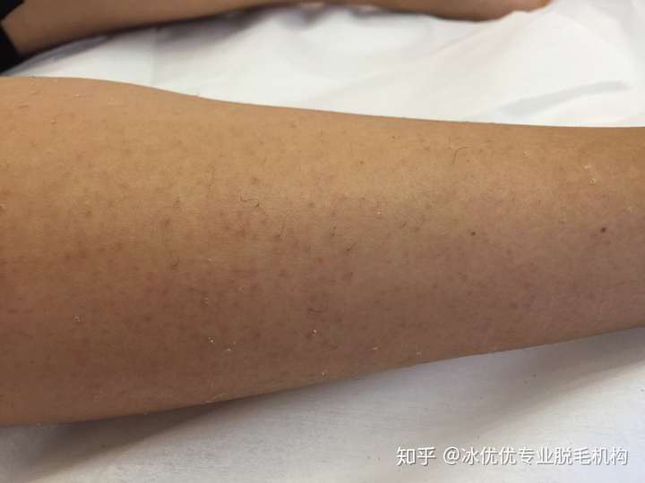 用脱毛膏会对皮肤造成伤害吗?