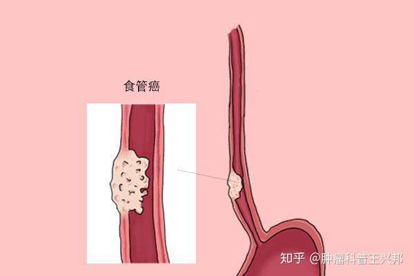 容易转移到什么部位?癌友应提早了解