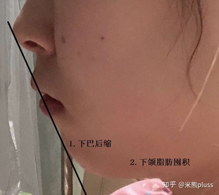 我这样的下巴后缩如何改善啊?