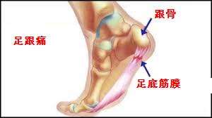 跟骨骨膜炎·足底跖筋膜炎同病名本病指由多种原因所致的后足跟疼痛