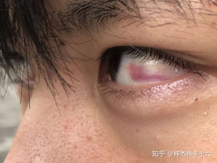 眼睛白色部分有血块是怎么回事呀