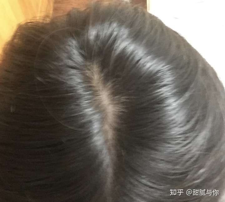 女生脱发严重怎么办?