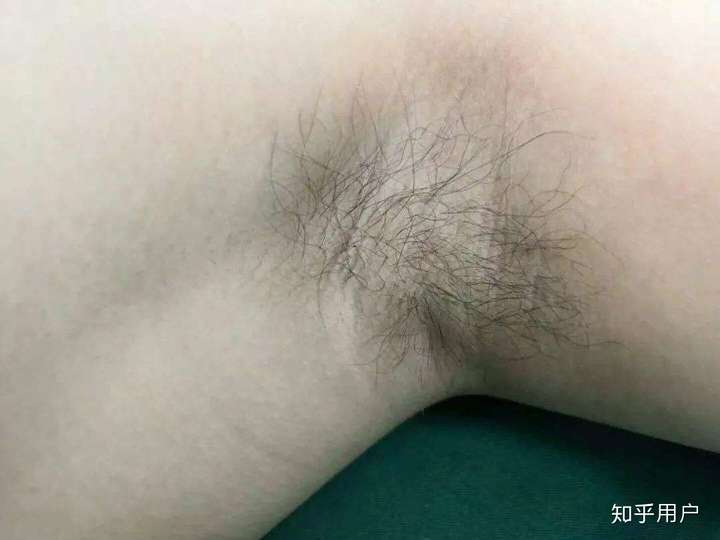 随着年龄增长,腋毛长长会引起腋臭吗?