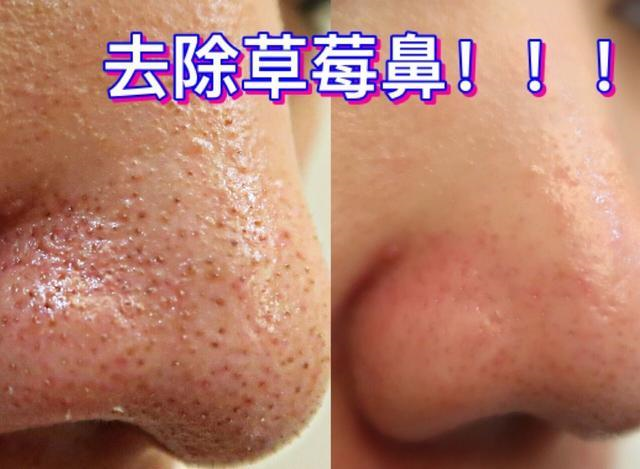 女士如何去黑头?