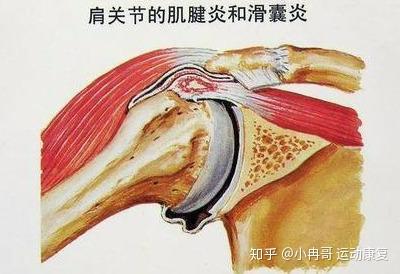 肩部的常见损伤二关于滑膜炎肌腱损伤的康复训练方法
