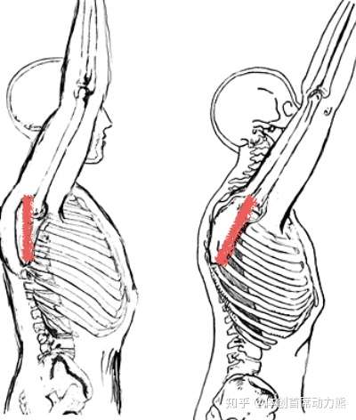 从您的图片来看,是肩胛下角翘起的翼状肩问题,是肩胛骨过度前倾导致的