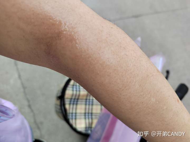 想问一下大家,用完脱毛膏有没有红肿过敏或者其他副作用?