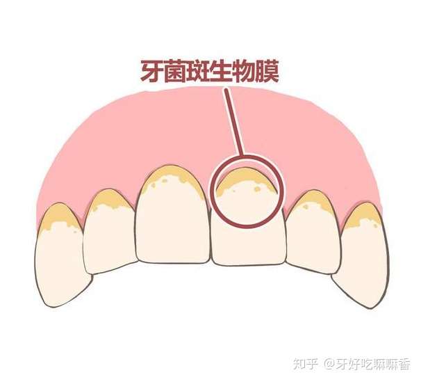 牙齿坏了的元凶是牙菌斑真是意外