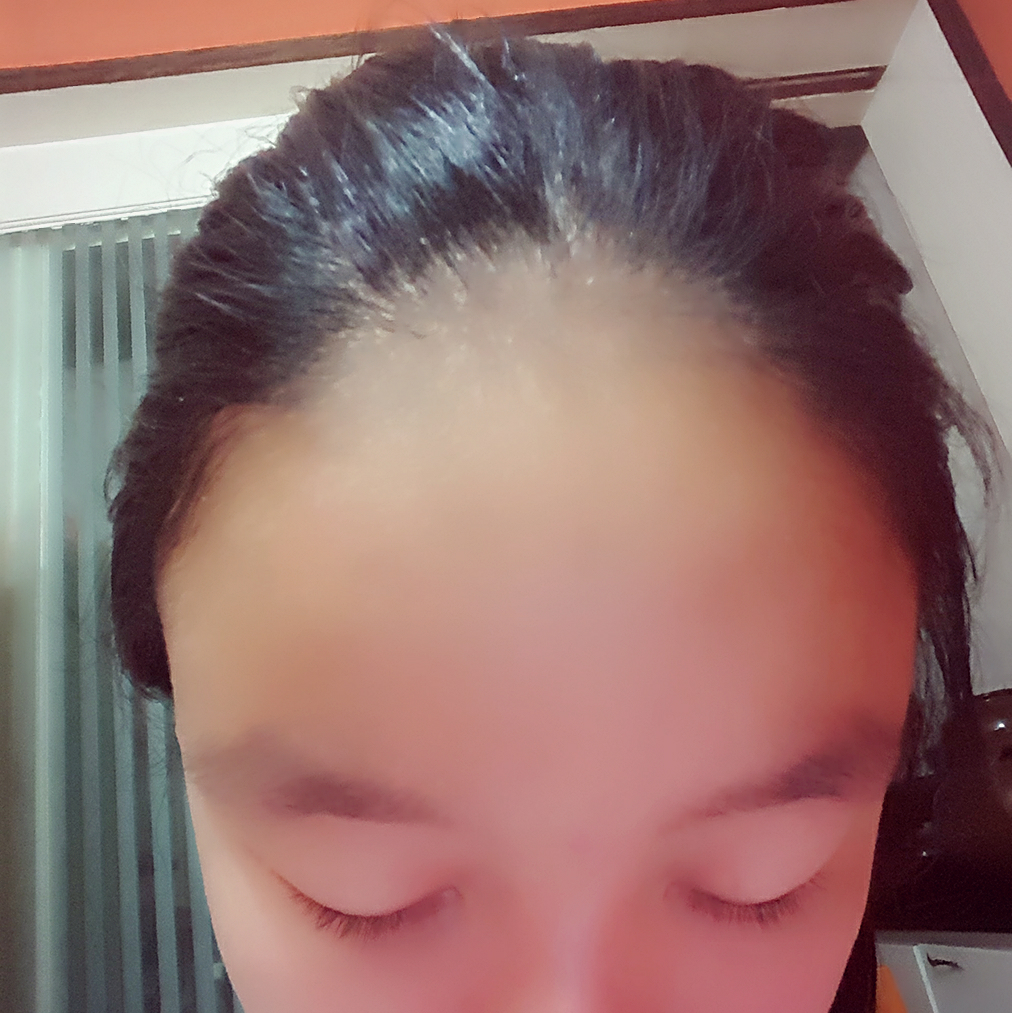 初中生掉<em>头发</em>正常吗? - 病房里的奈奈安的回答