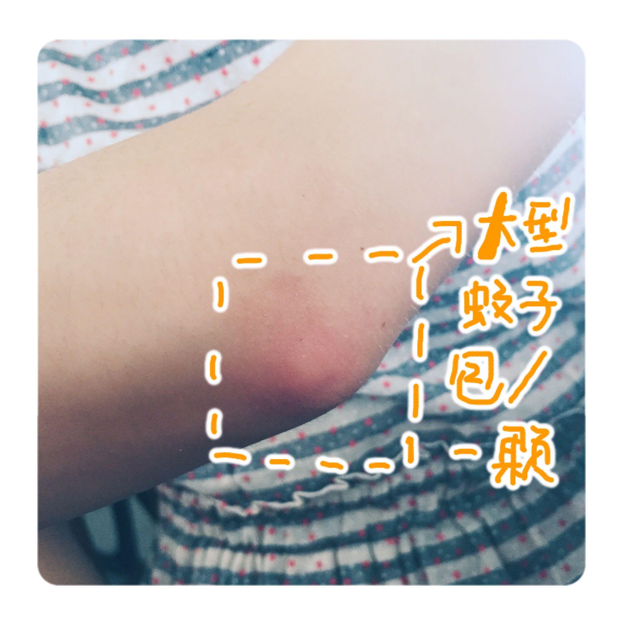 经常被蚊子叮,苦不堪言啊!(_) 如何有效解决蚊子