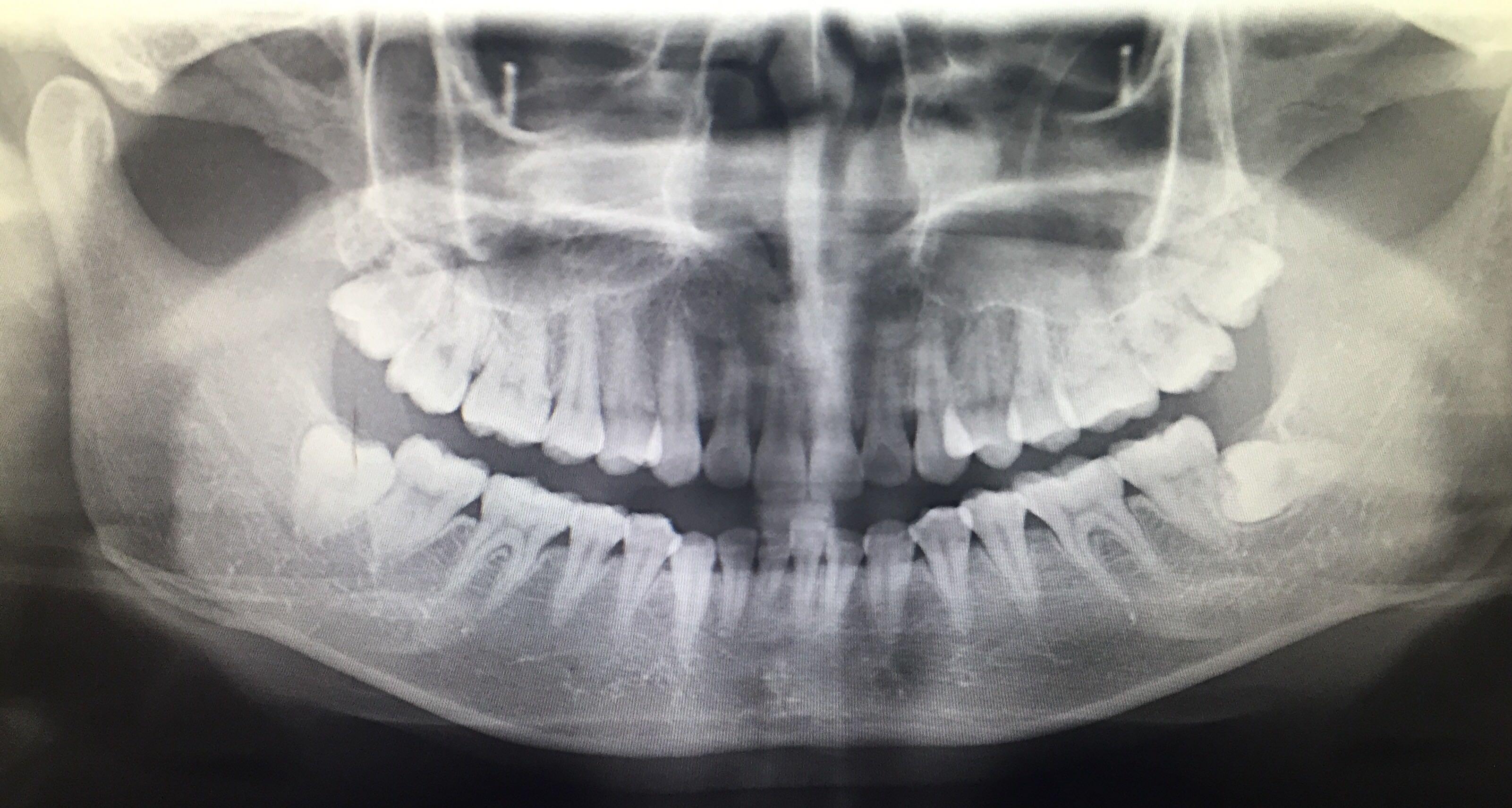 拔水平阻生智齿有必要填骨粉吗? - 李彦德的回