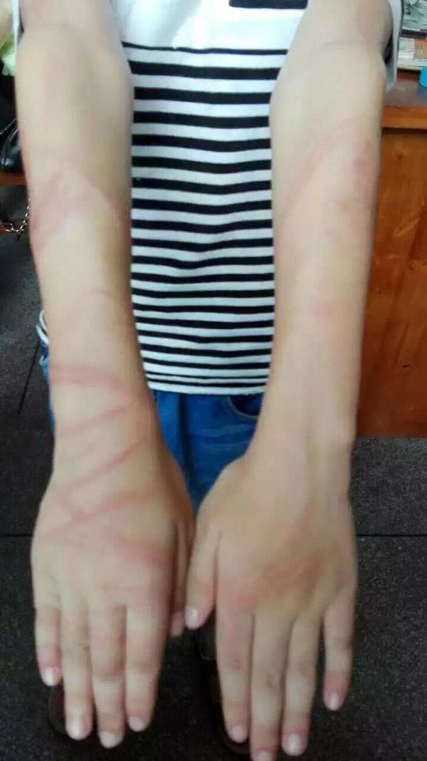被父母打得伤痕累累的孩子,我该怎样才能帮助他?