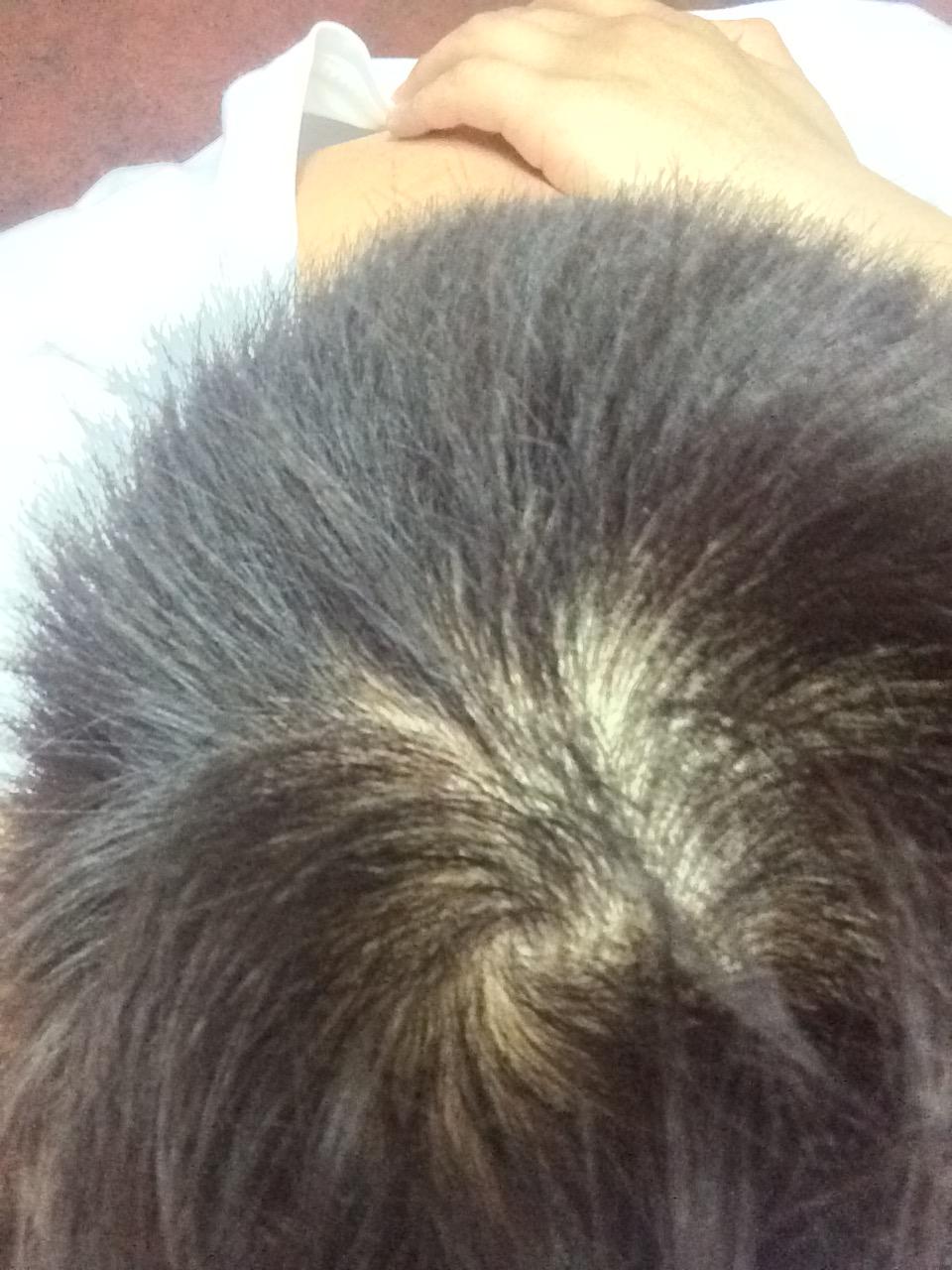 前段时间脱发,现在不脱了,但是<em>头发变得细软</em>,请