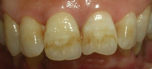 怎样使牙齿重新变白? - 肖小诗的回答