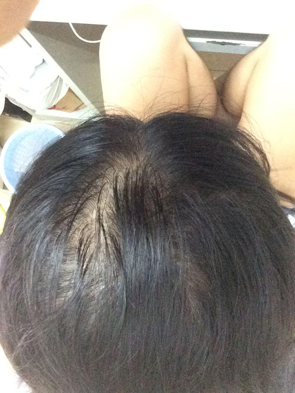 <em>女生</em>22,三年前发现<em>头发</em>越来越<em>少</em>,<em>头发</em>细软少,医