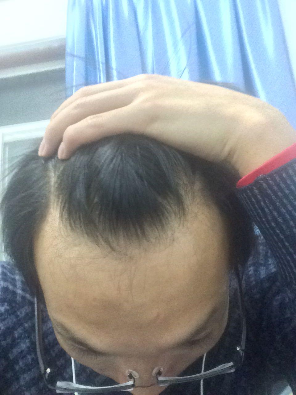 <em>24岁头发</em>已经脱成这样,怎么办? - 匿名用户的回