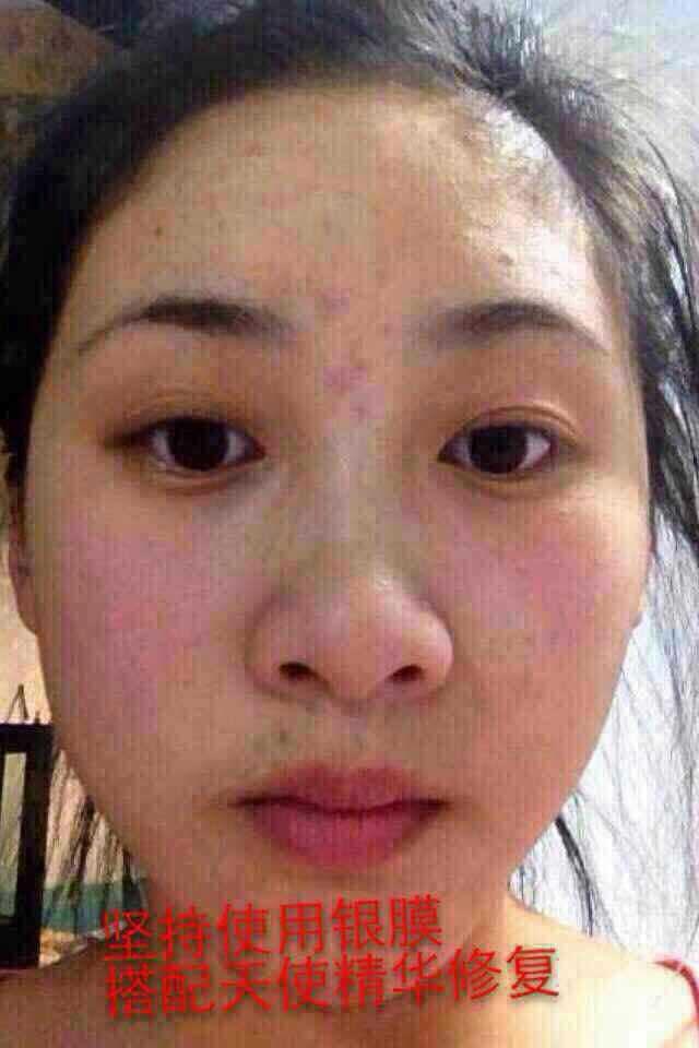 我很喜欢吃辣 但很容易长痘 一吃火锅之类的就