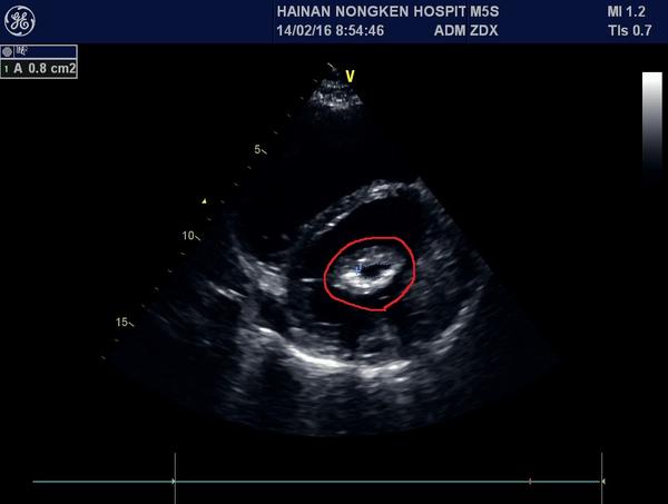 二:二尖瓣水平短轴切面鱼嘴样改变
