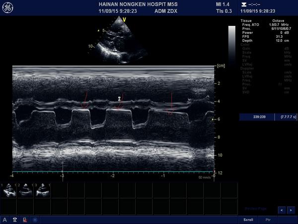 教你读懂彩超之风湿性心脏病