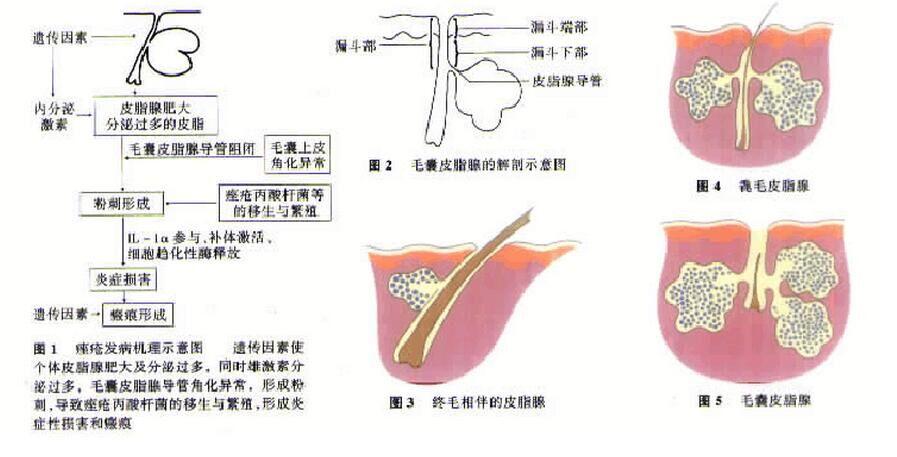 痤疮是毛囊皮脂腺的慢性炎症.