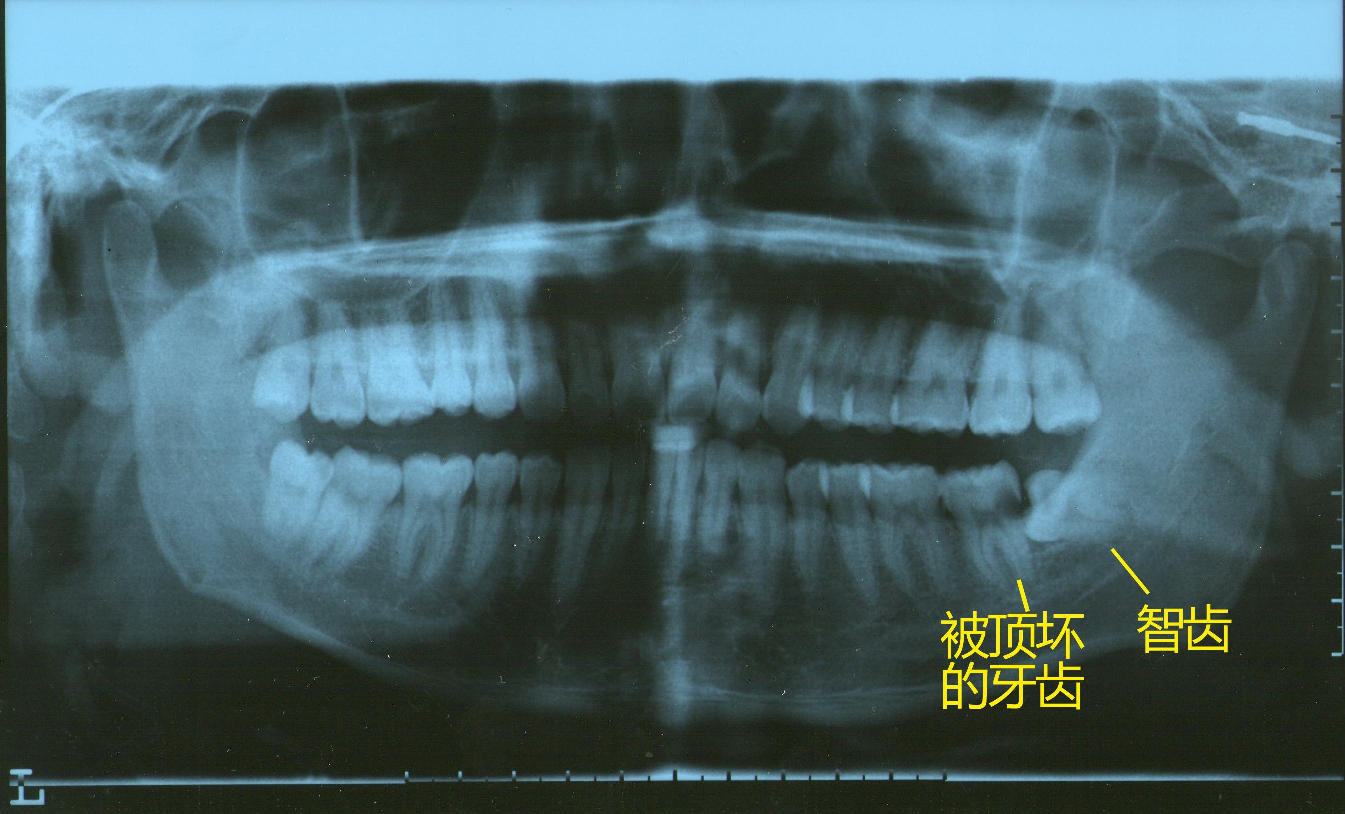 这是医院做的的牙齿曲面全片,显示:由于右下智齿的横向生长,顶坏了