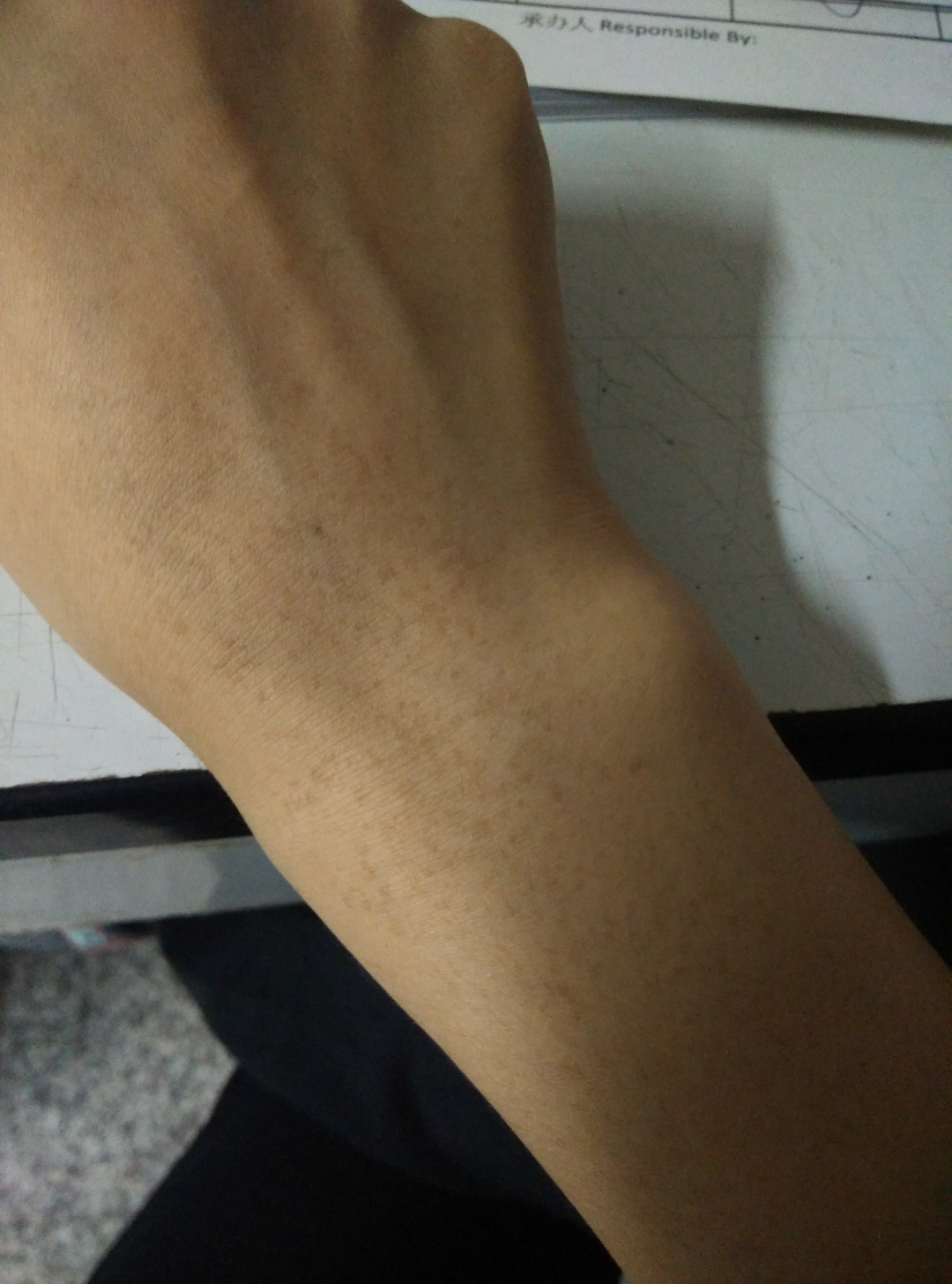 上图 据说这是老年斑,我不仅手背上有,整个小臂外侧都有