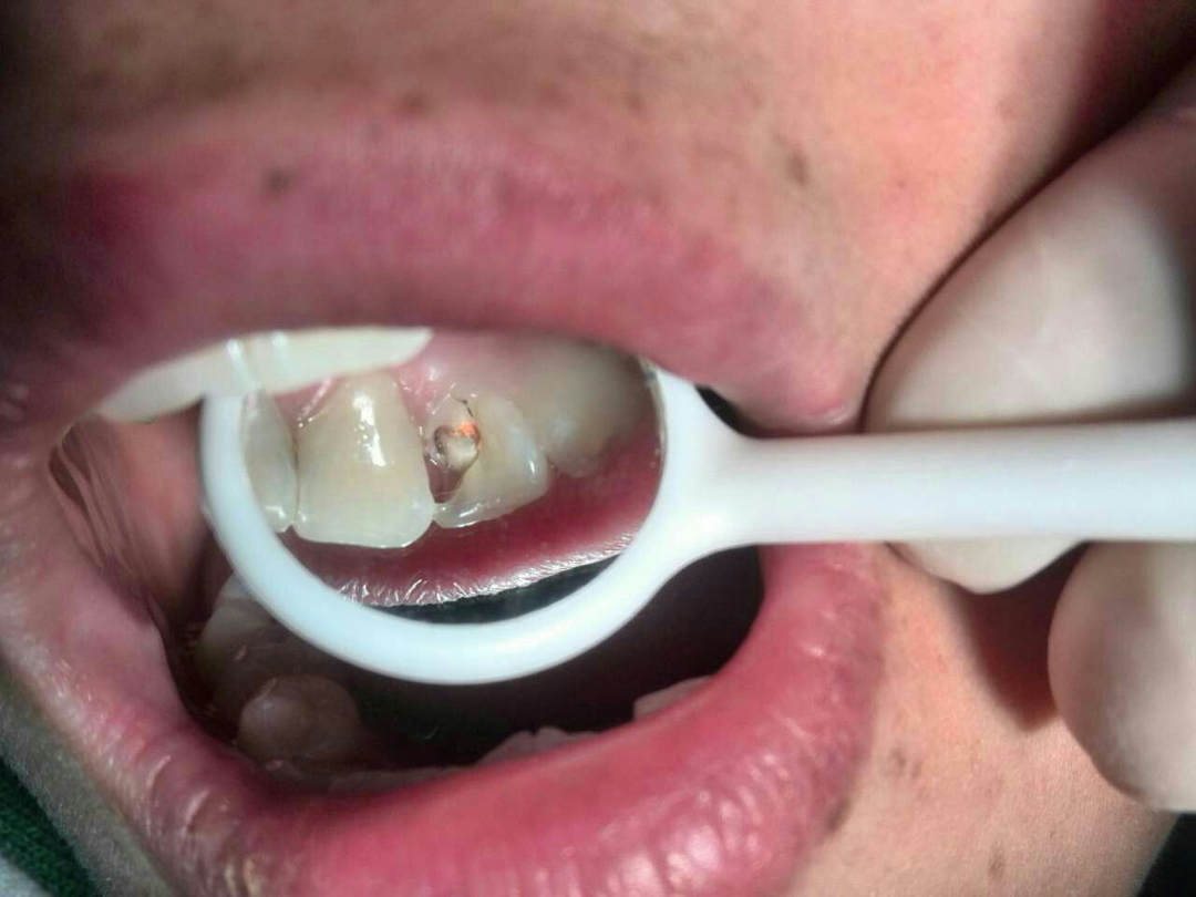 牙缝中间龋齿应该怎么处理呢?