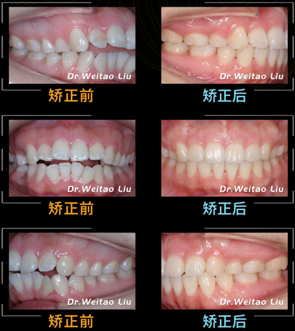 刘伟涛医生牙齿开颌矫正案例
