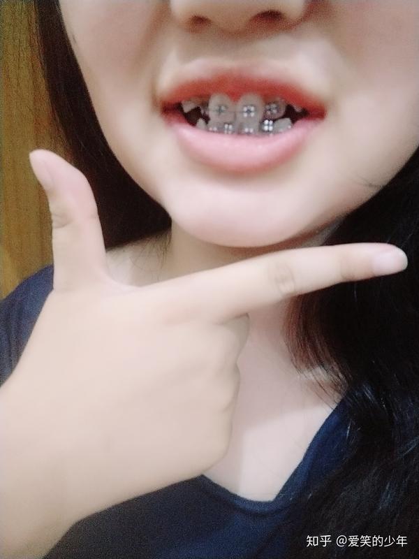 牙齿正畸结束摘掉牙套是怎样的体验
