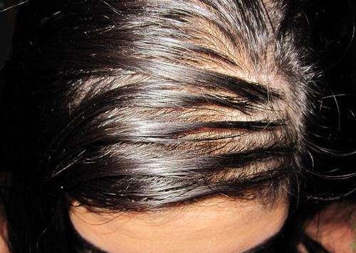 头发油腻是什么原因