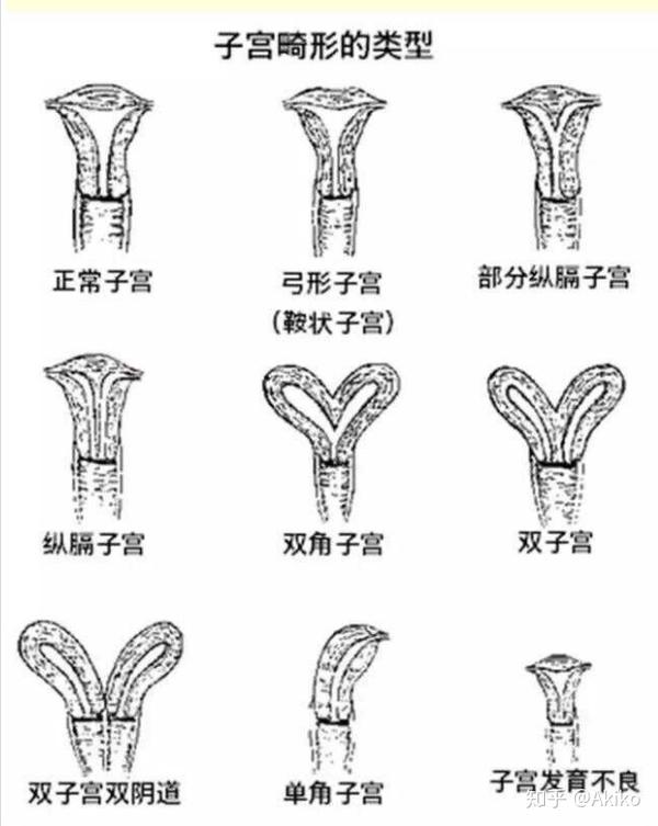 双子宫为两侧副中肾管未融合,各自发育形成两个单角子宫和两个宫颈
