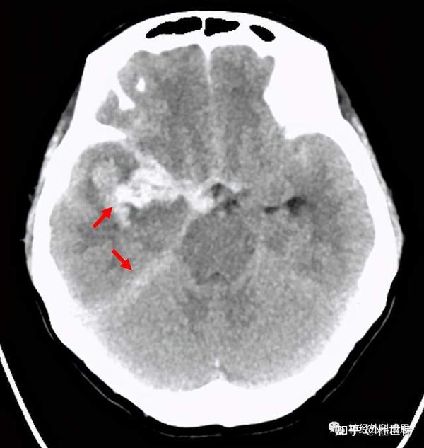 头颅ct(红色箭头为动脉瘤破裂出血导致的蛛网膜下腔出血及血肿)