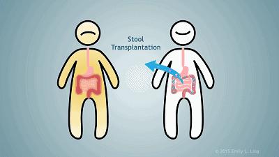 菌群移植常见的几种方式简介