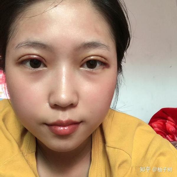 全切双眼皮术后效果,小内双的自救,教你如何眼睛大而有神,价格:6600