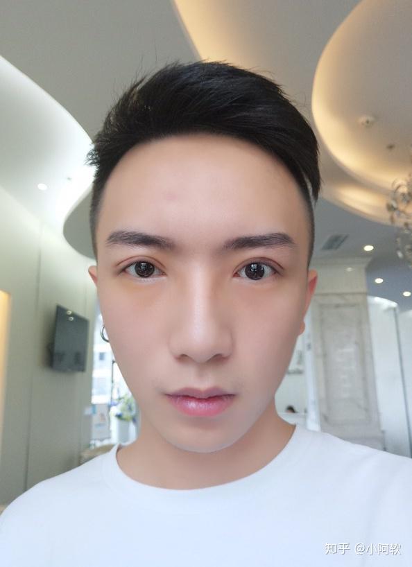 一个男人割完双眼皮的是什么样子