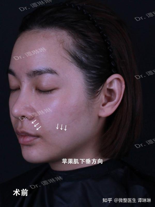 苹果肌下垂,凹陷该怎么办?
