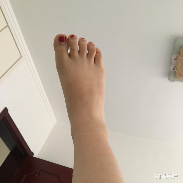 女生脚踝粗是基因决定的吗?