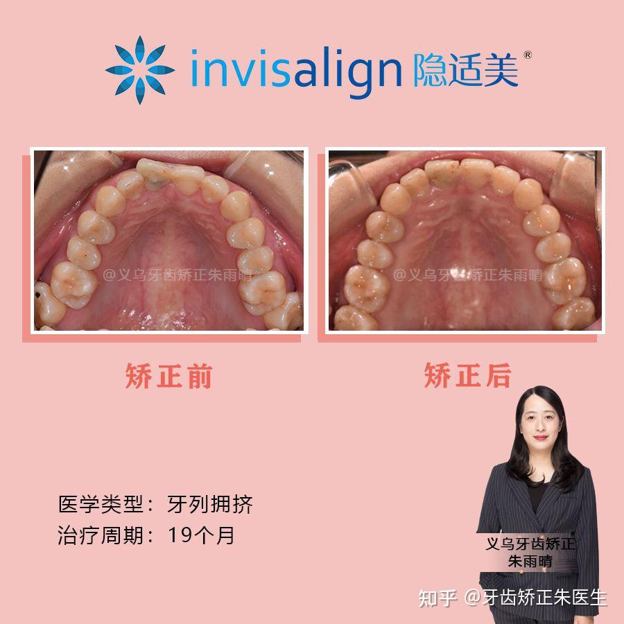 弹性牵引:安氏 ii 类治疗方案矫正周期:19个月矫正方法:隐形矫正医学